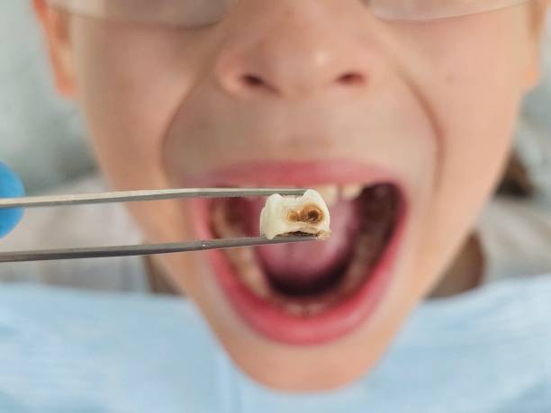 Best Emergency Dentist for Lost Fillings or Crowns in Mountain Lakes, NJ